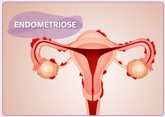 Tratamentos Scope Endometriose