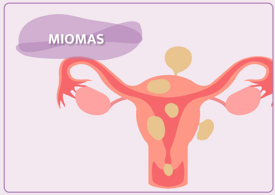 Tratamentos Scope Mioma