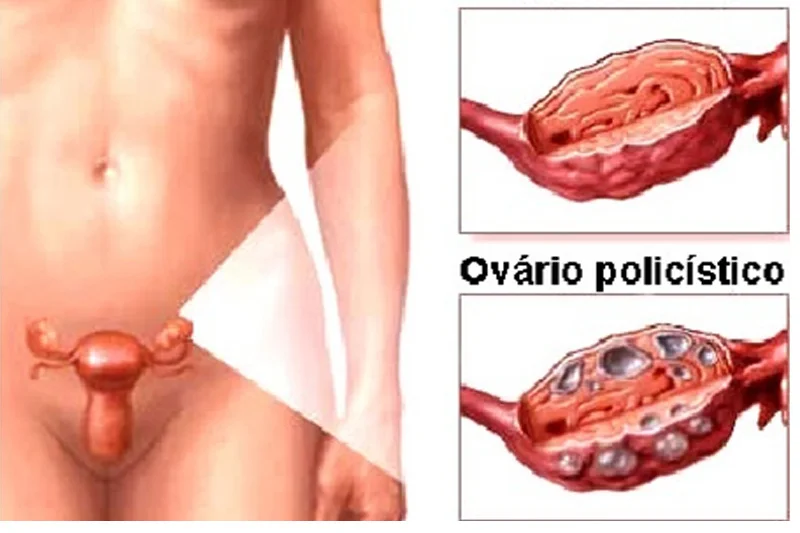 Ooforectomia e Ooforoplastia: causas e tratamentos