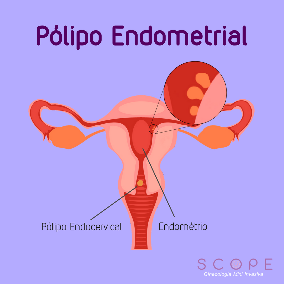 Pólipo endometrial: o que é e por que dificulta a gestação