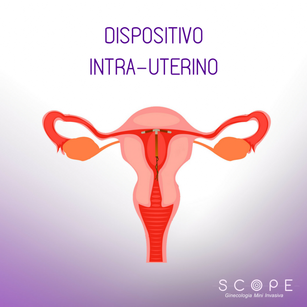 DIU: mitos e verdades sobre o contraceptivo intrauterino