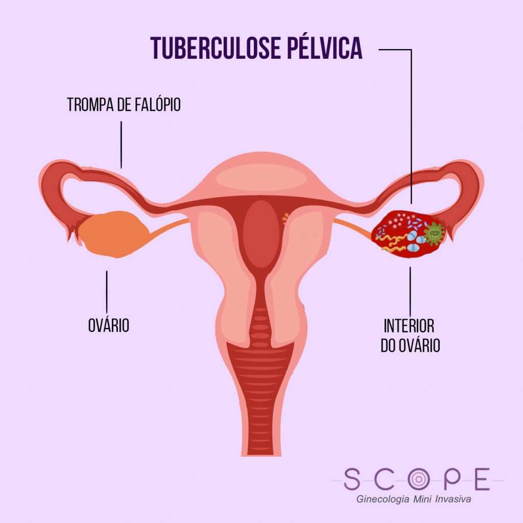 Tuberculose pélvica: infecção por bactéria pode causar infertilidade