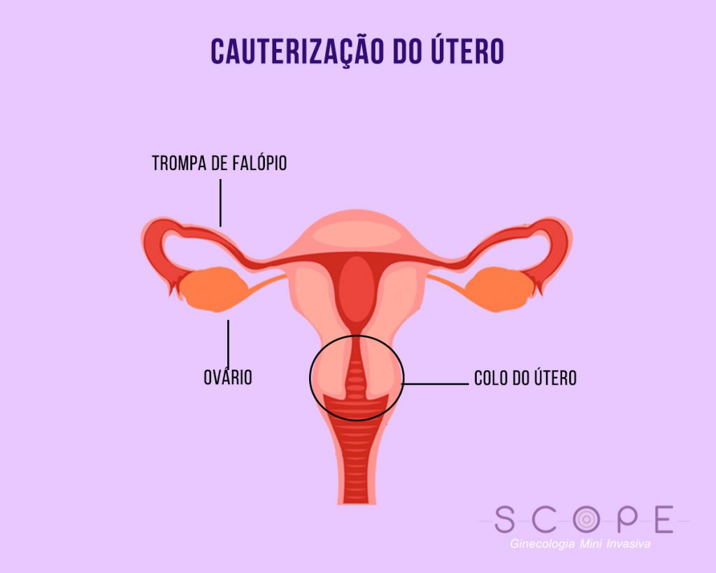 Cauterização do útero: o que é e quais as indicações