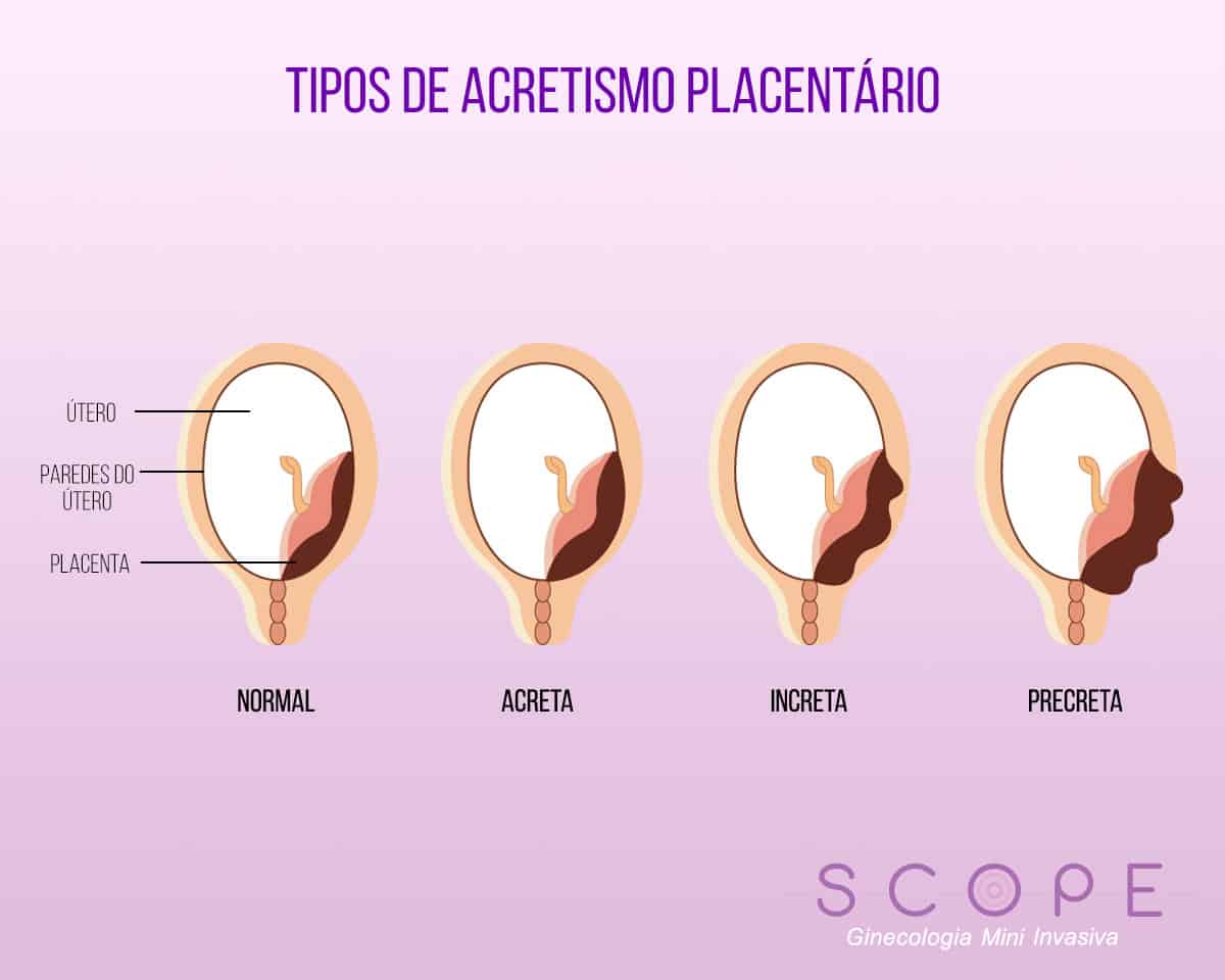 Acretismo placentário: patologia pode levar à remoção do útero - SCOPE