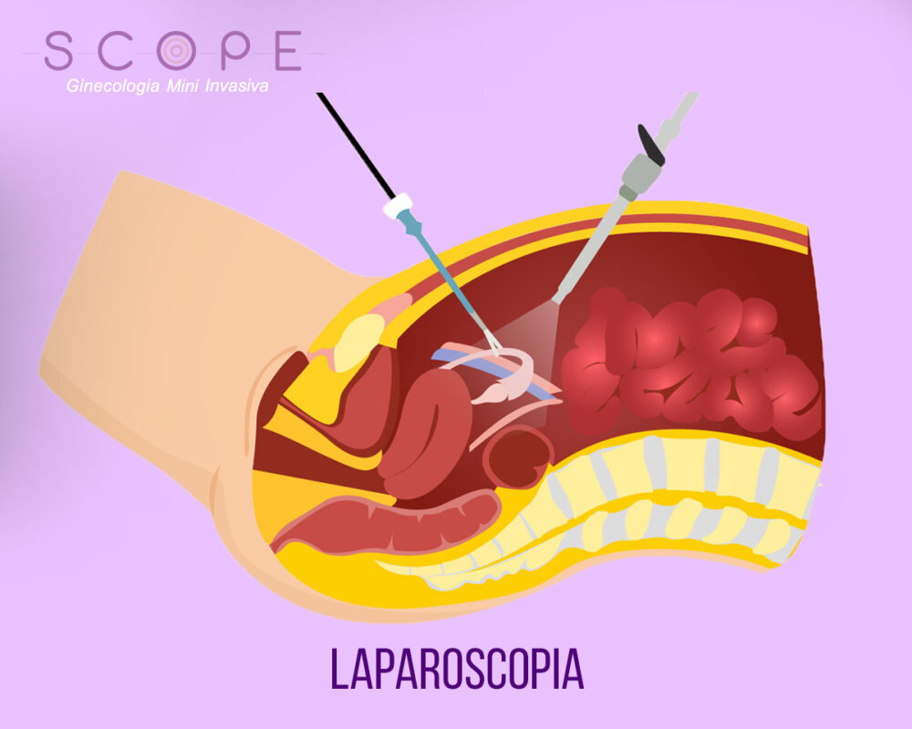 Laparoscopia e Videolaparoscopia Diagnóstica e Cirúrgica
