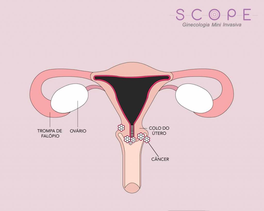 Doenças que o exame de videohisteroscopia pode identificar - Scope  Ginecologia