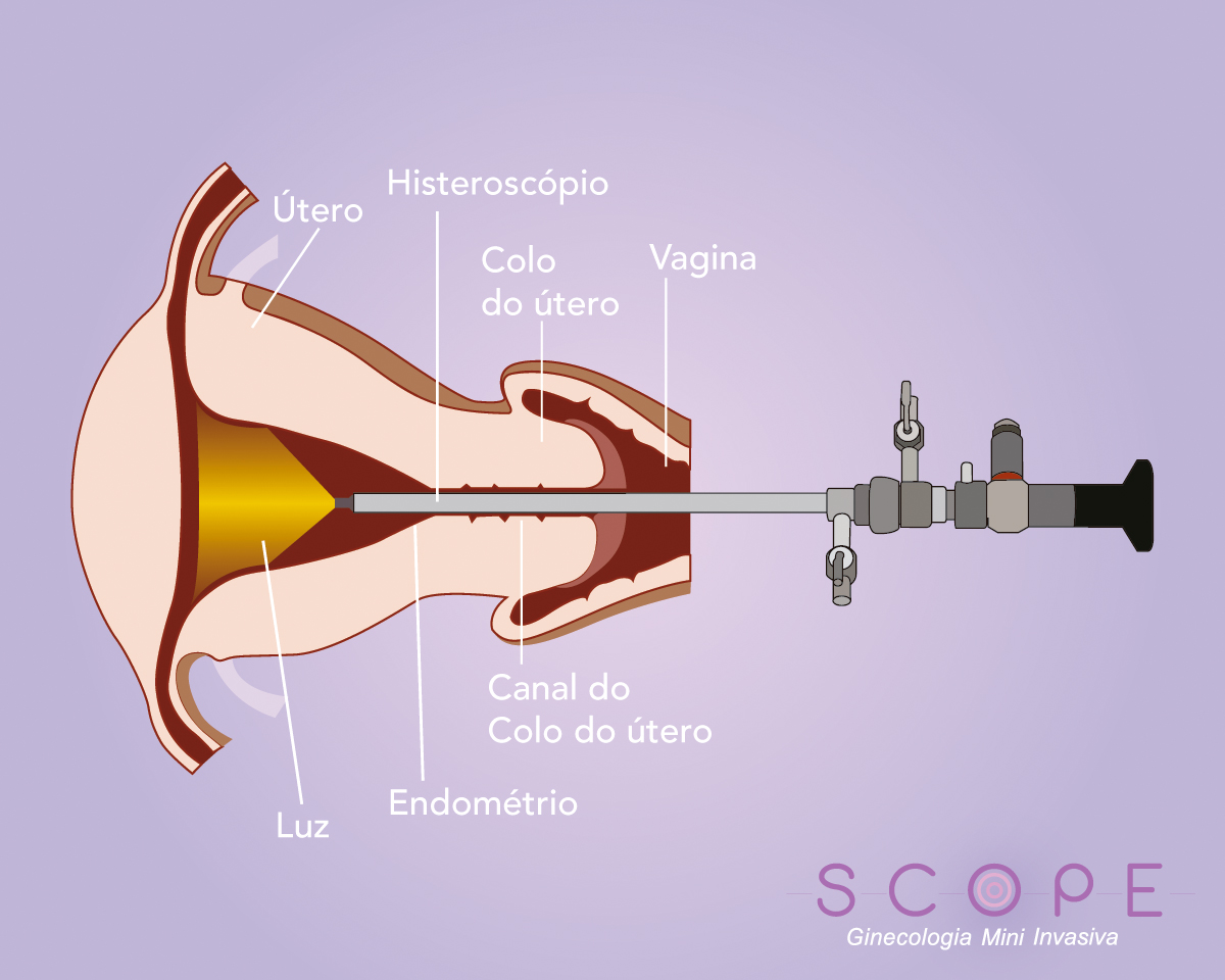 Saiba o que é a Ooforoplastia