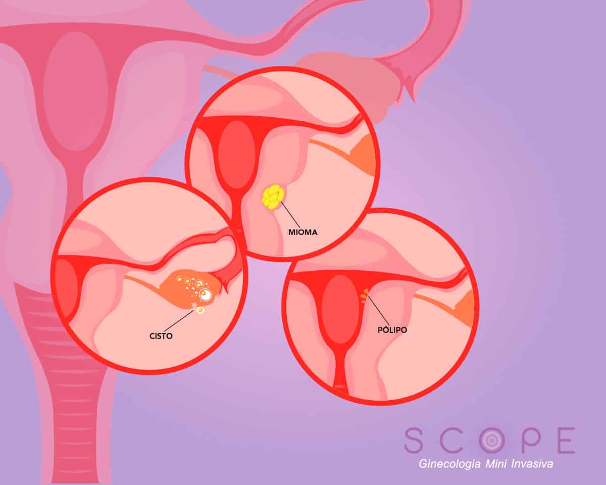 Mioma, pólipo e cisto: entenda as diferenças e tratamentos