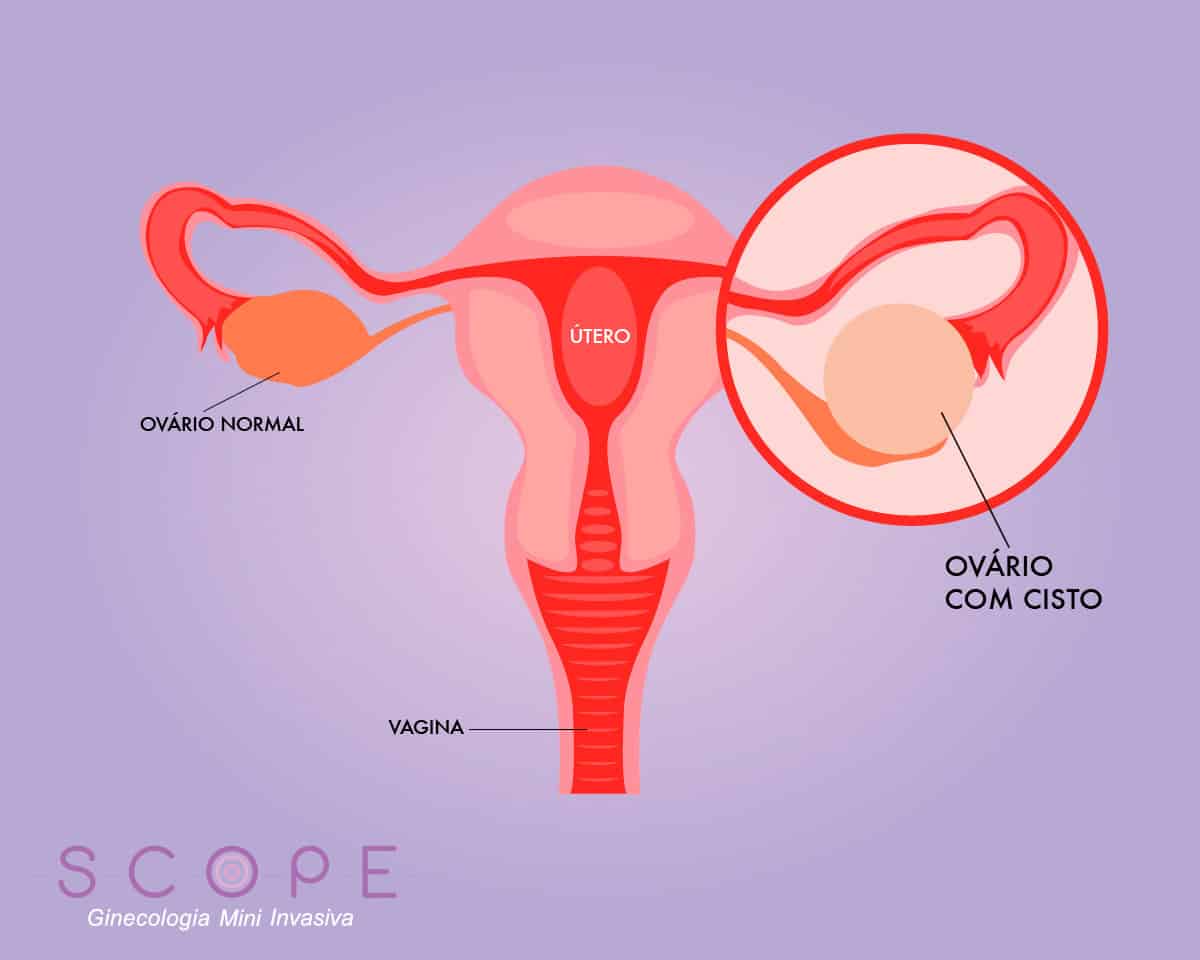 Endometrioma: sintomas, diagnóstico e tratamento