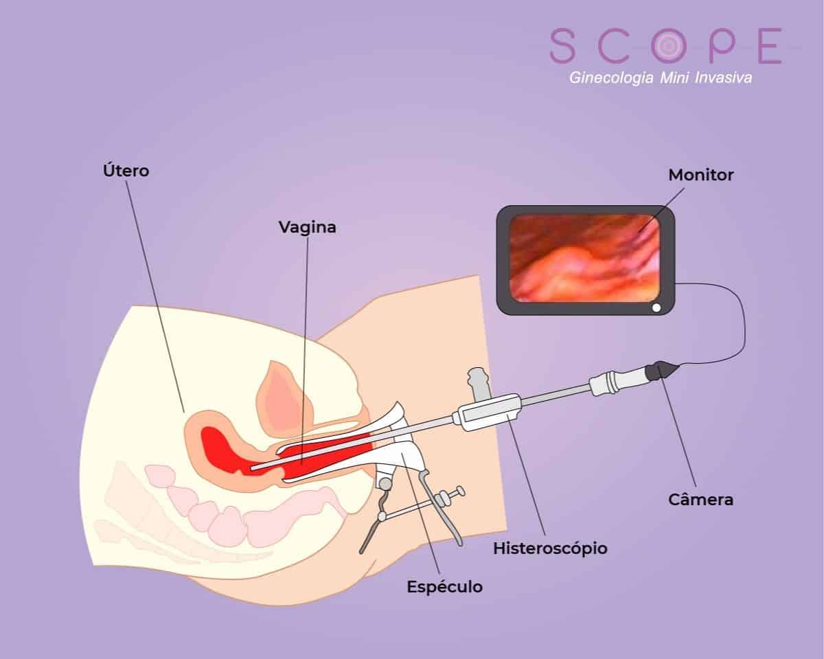 Para que serve e como é feita a videohisteroscopia cirúrgica