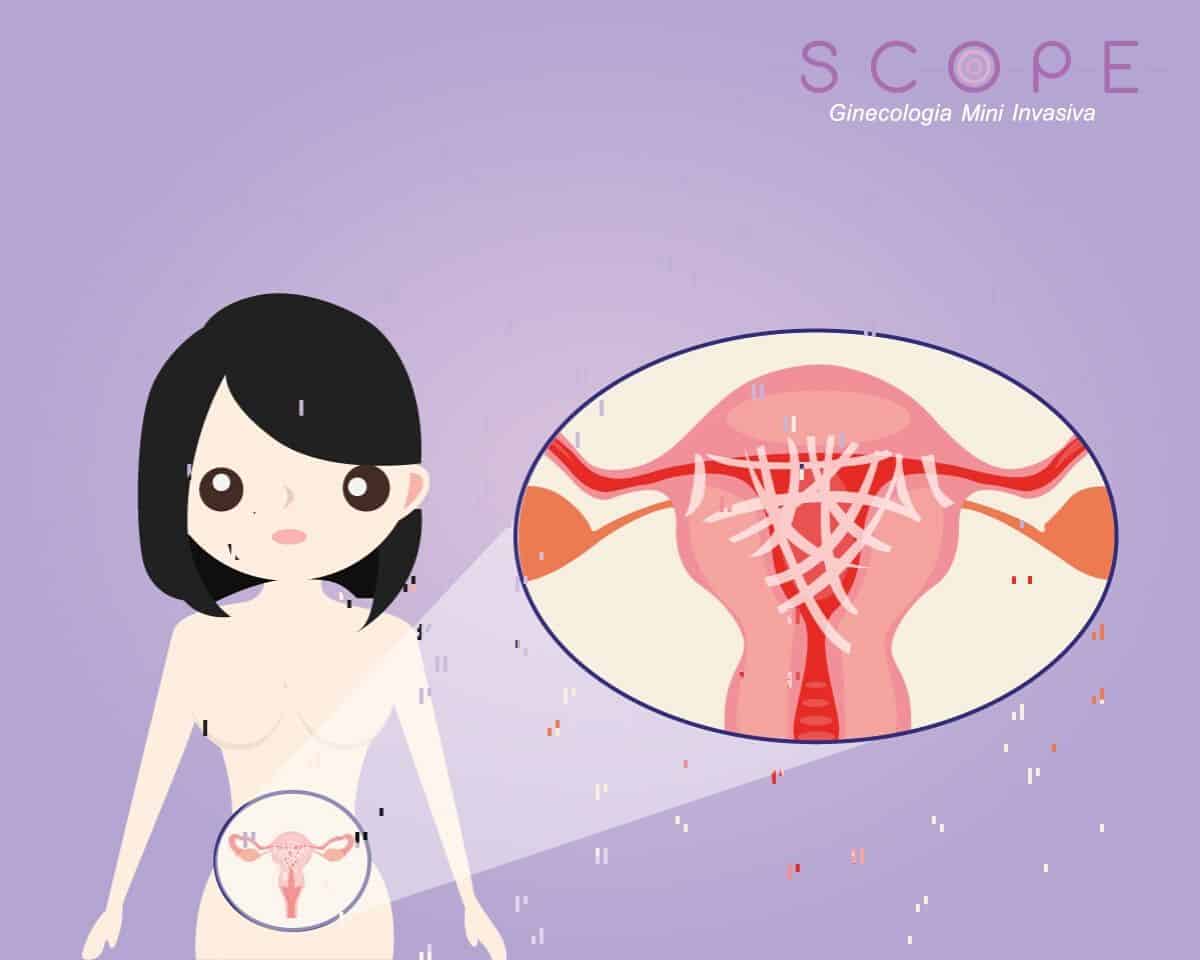 Sinéquias uterinas: diagnóstico e tratamento por videohisteroscopia