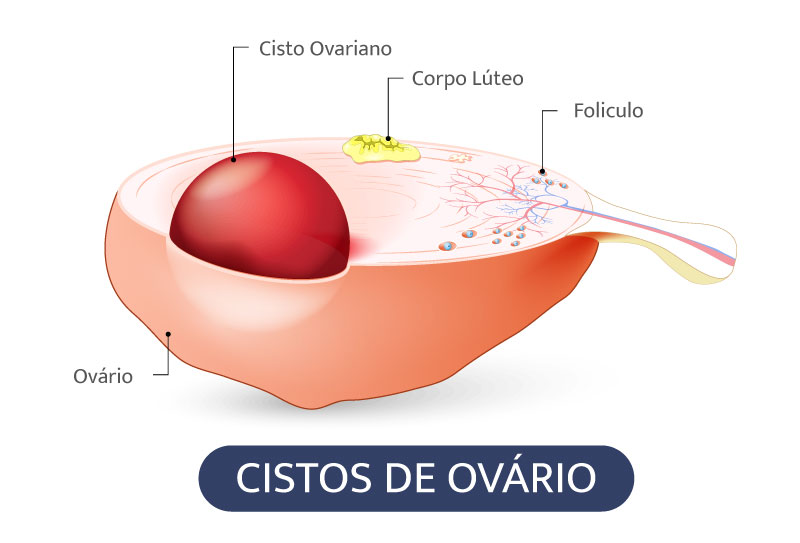 Cistos de Ovário