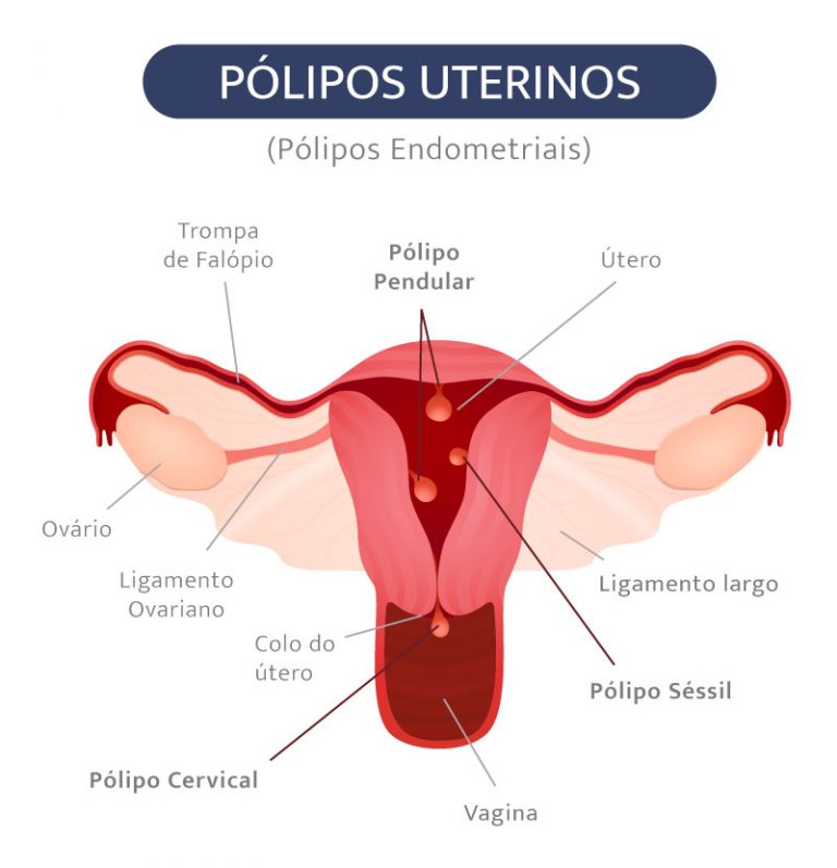 Pólipo Endometrial - Scope Ginecologia